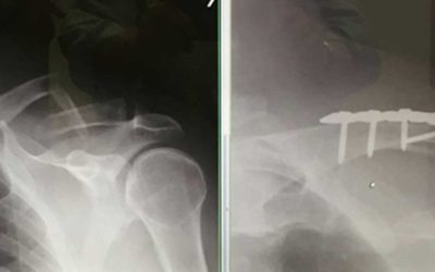 ¡Me Fracturé la Clavícula!